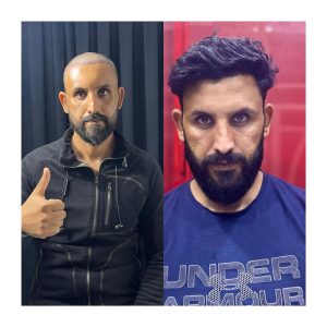 HairXNose hair transplant before and after case image 7