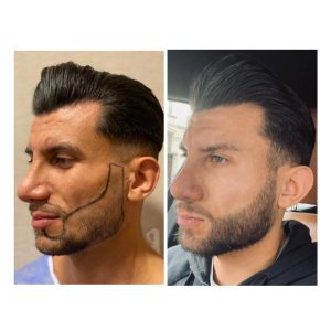 HairXNose hair transplant before and after case image 8