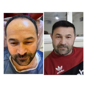 HairXNose hair transplant before and after case image 9