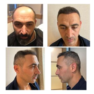 HairXNose hair transplant before and after case image 10