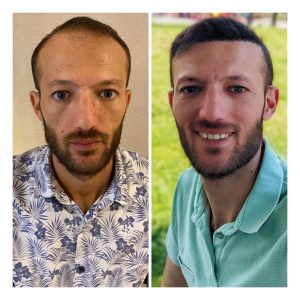 HairXNose hair transplant before and after case image 11
