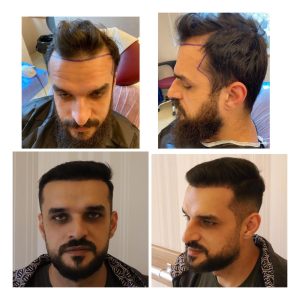 HairXNose hair transplant before and after case image 12