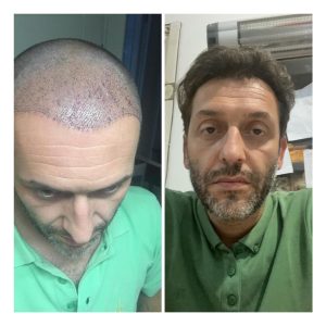 HairXNose hair transplant before and after case image 13