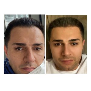 HairXNose hair transplant before and after case image 14