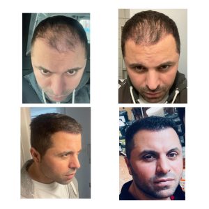HairXNose hair transplant before and after case image 15