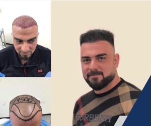 HairXNose hair transplant before and after case image 16