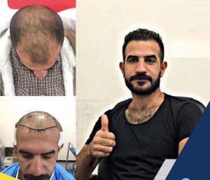 HairXNose hair transplant before and after case image 17