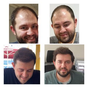 HairXNose hair transplant before and after case image 18