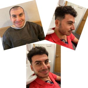 HairXNose hair transplant before and after case image 19