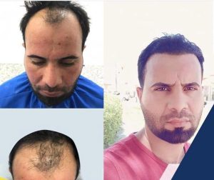 HairXNose hair transplant before and after case image 21