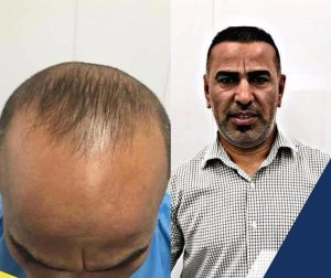 HairXNose hair transplant before and after case image 22
