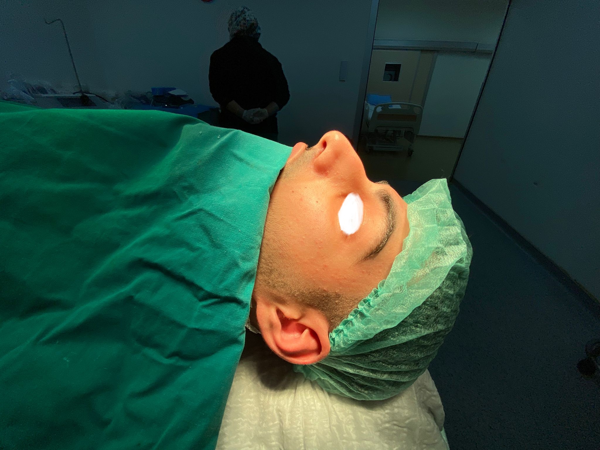 HairXNose rhinoplasty before and after case image 7