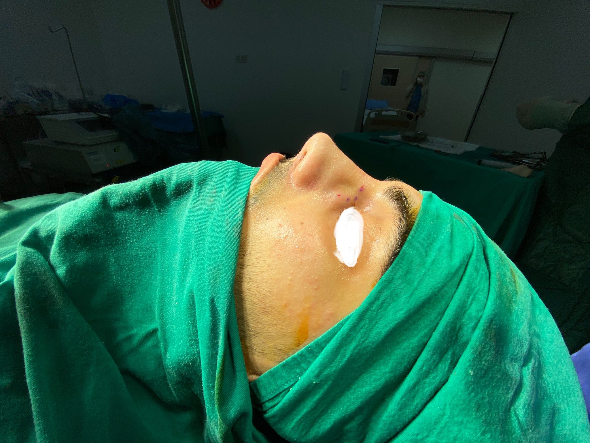 HairXNose rhinoplasty before and after case image 8