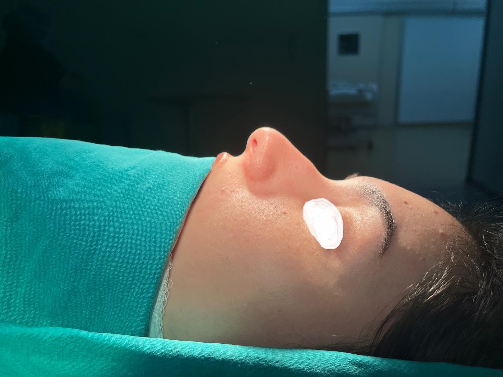 HairXNose rhinoplasty before and after case image 9