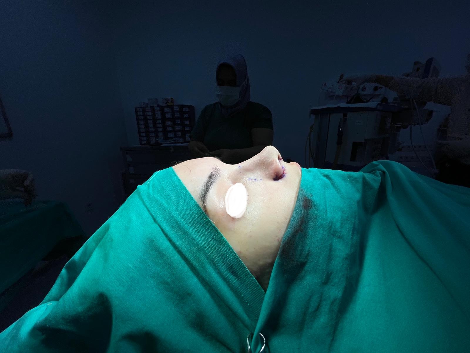 HairXNose rhinoplasty before and after case image 10