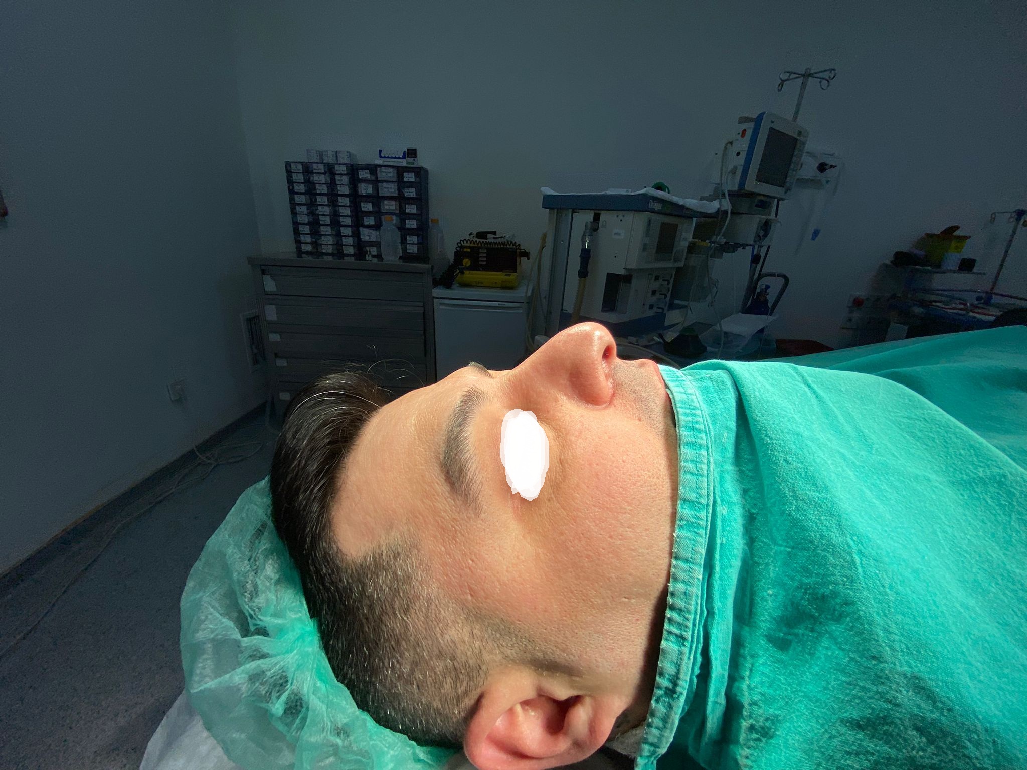 HairXNose rhinoplasty before and after case image 11