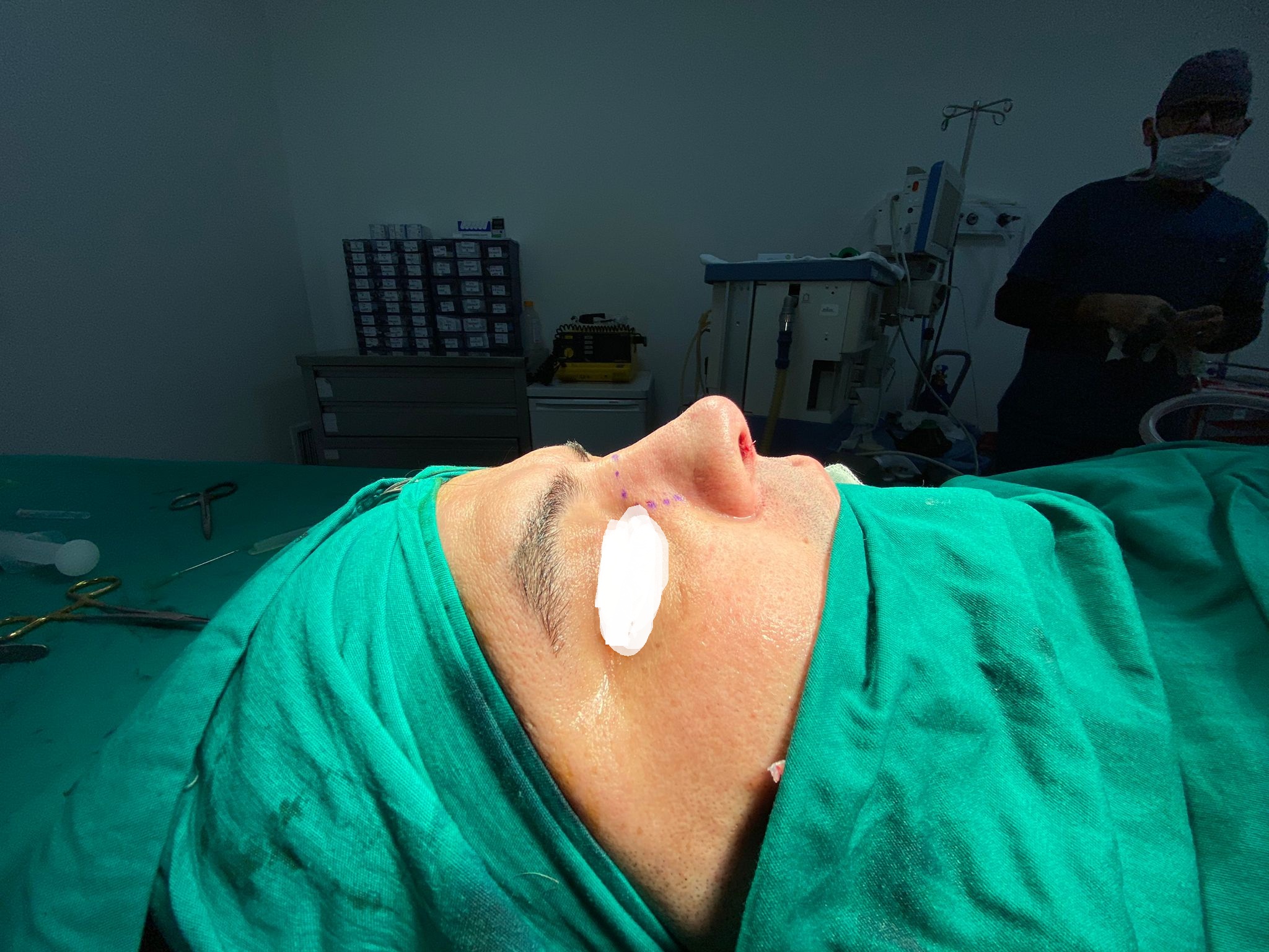 HairXNose rhinoplasty before and after case image 12