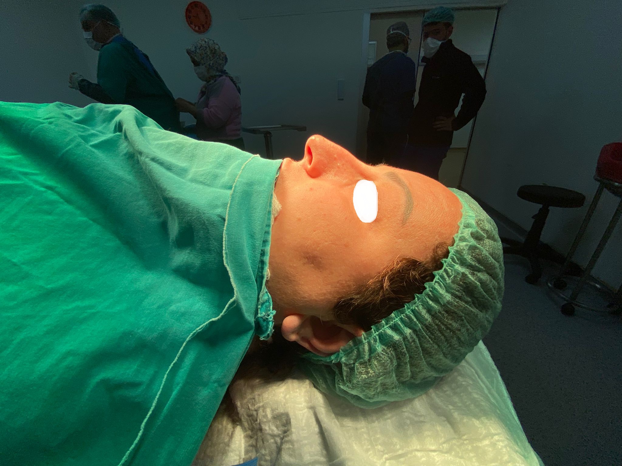 HairXNose rhinoplasty before and after case image 13