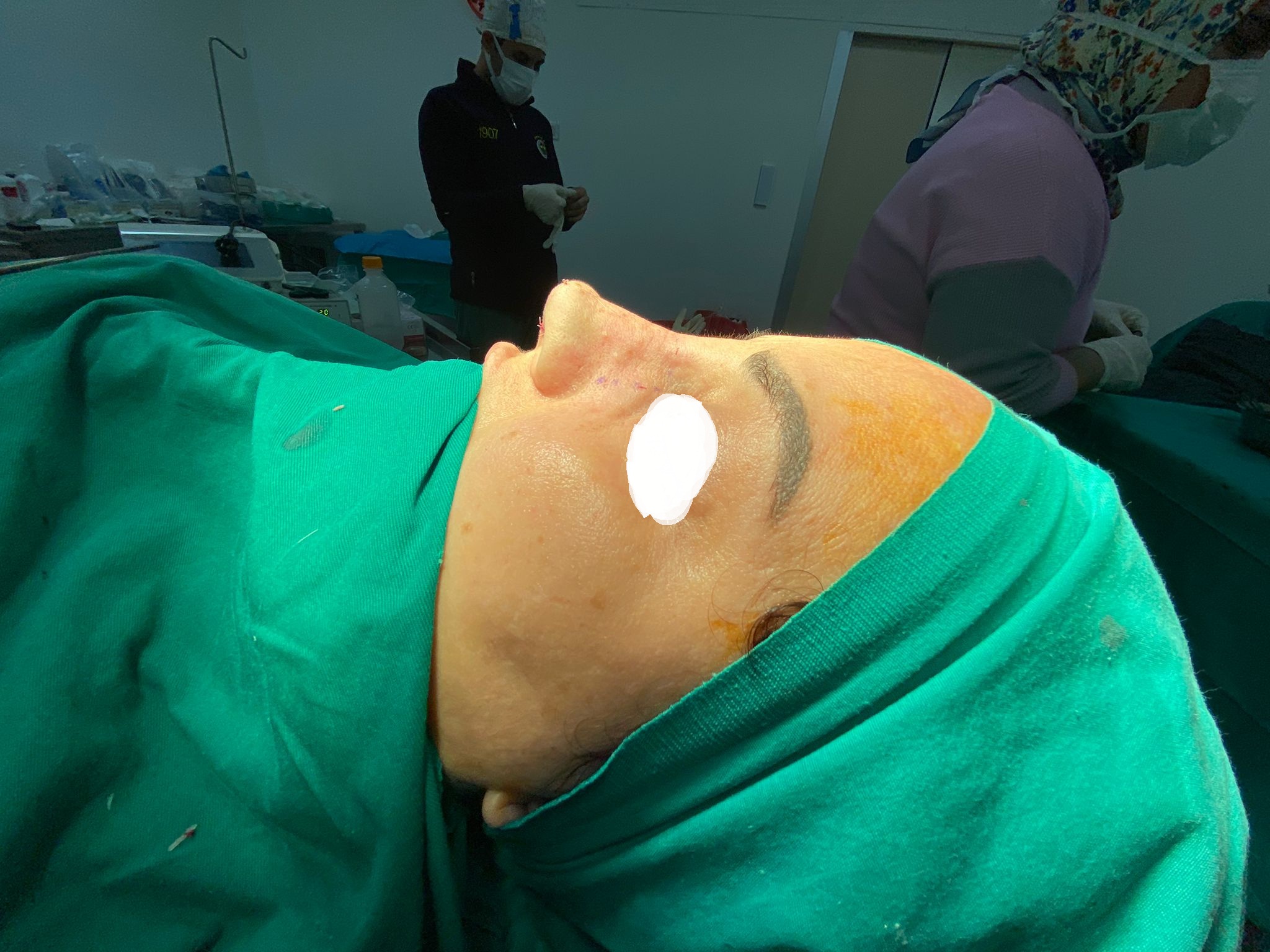 HairXNose rhinoplasty before and after case image 14