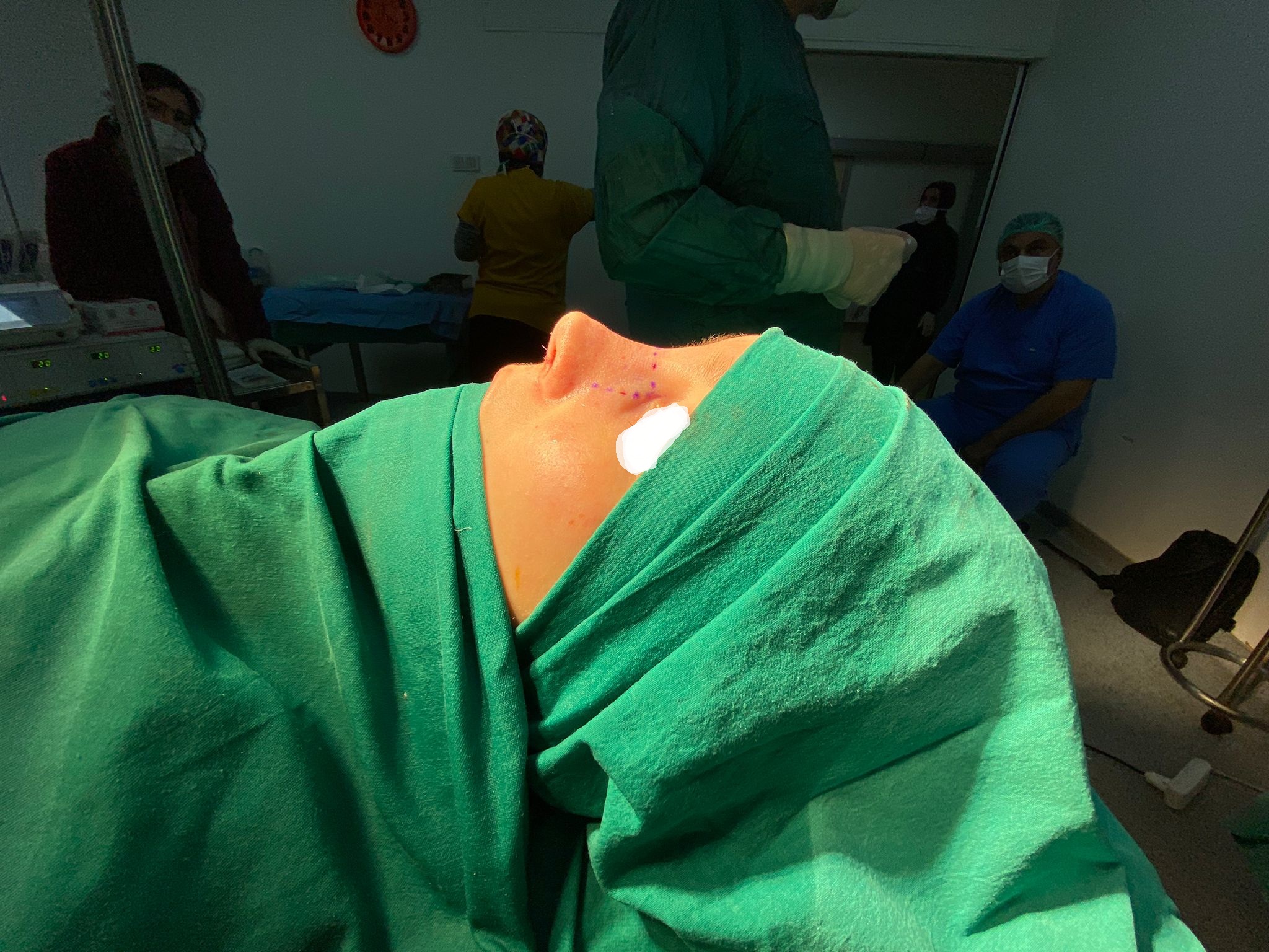 HairXNose rhinoplasty before and after case image 16