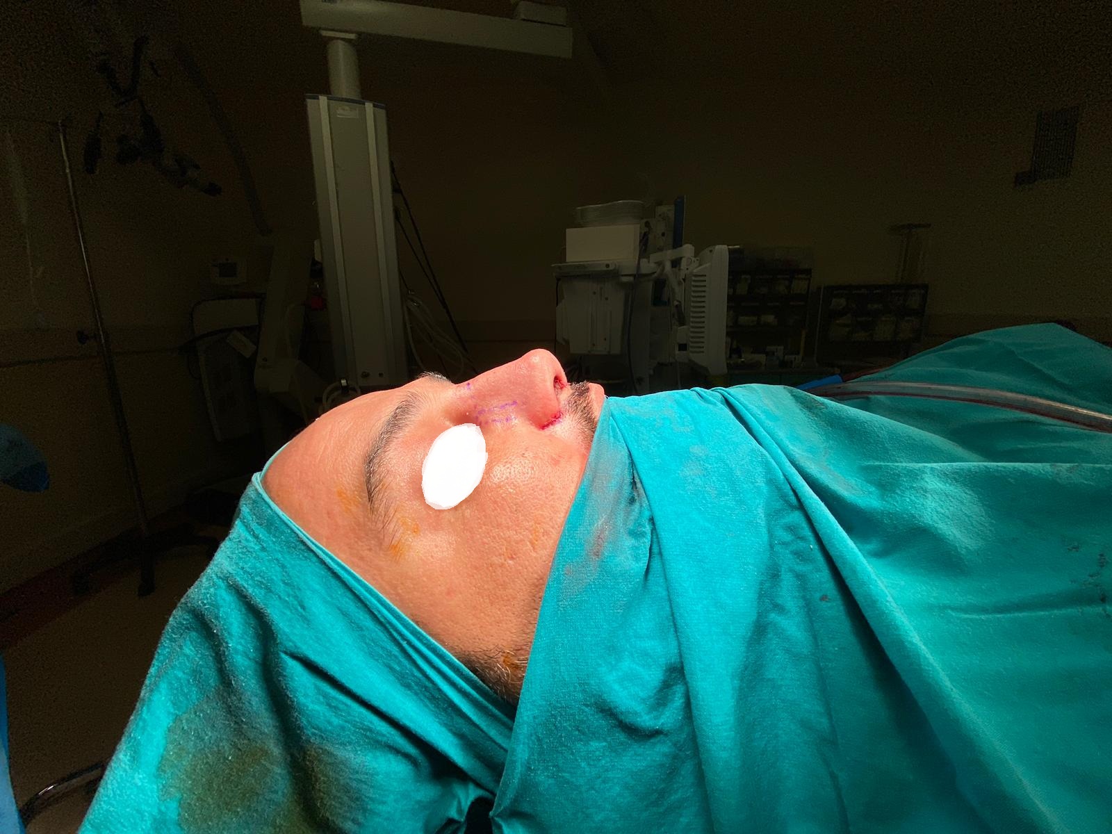 HairXNose rhinoplasty before and after case image 18