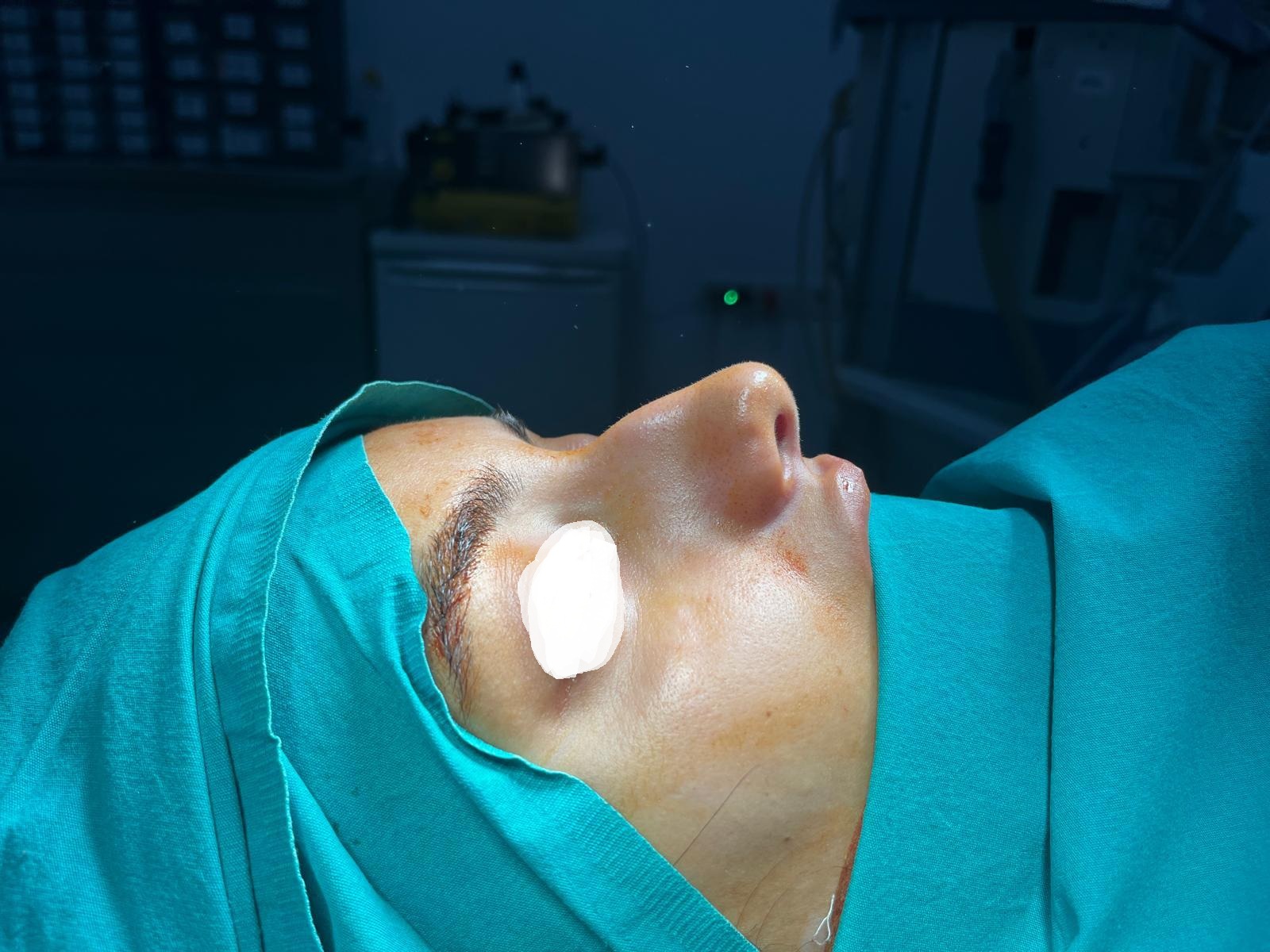HairXNose rhinoplasty before and after case image 19