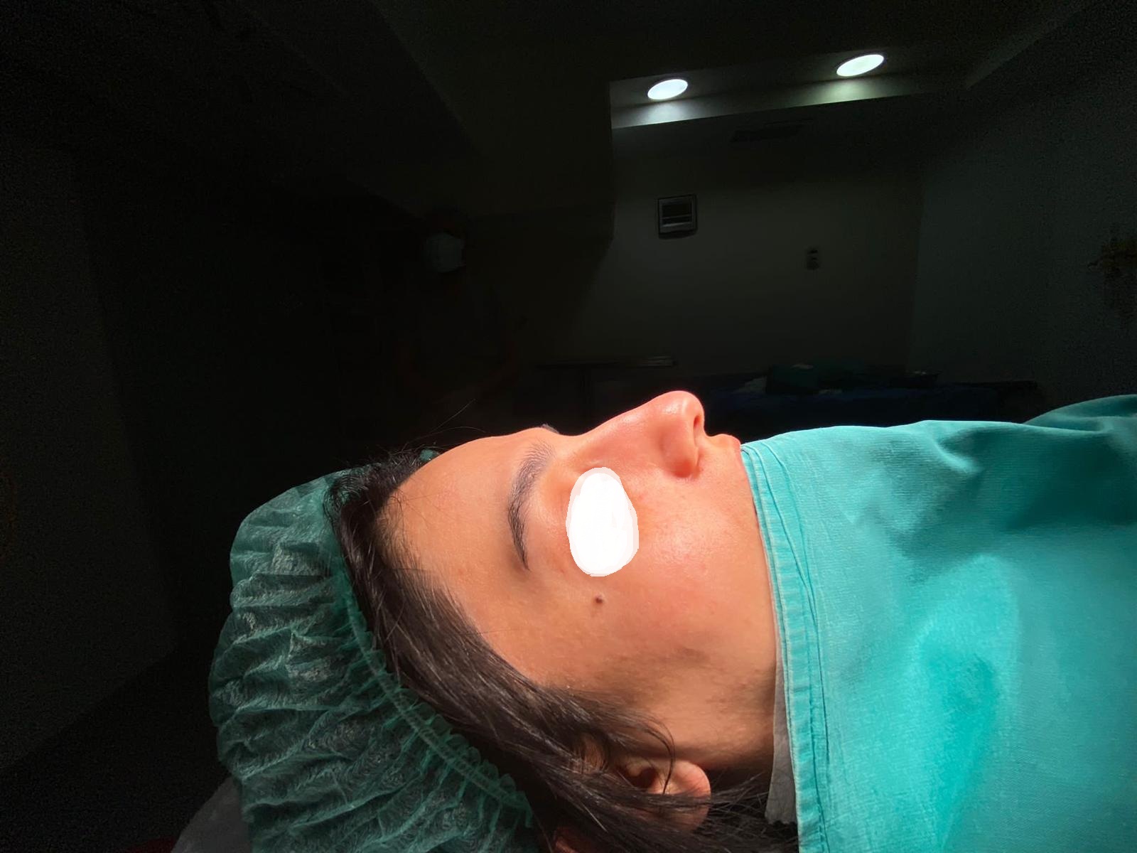 HairXNose rhinoplasty before and after case image 20