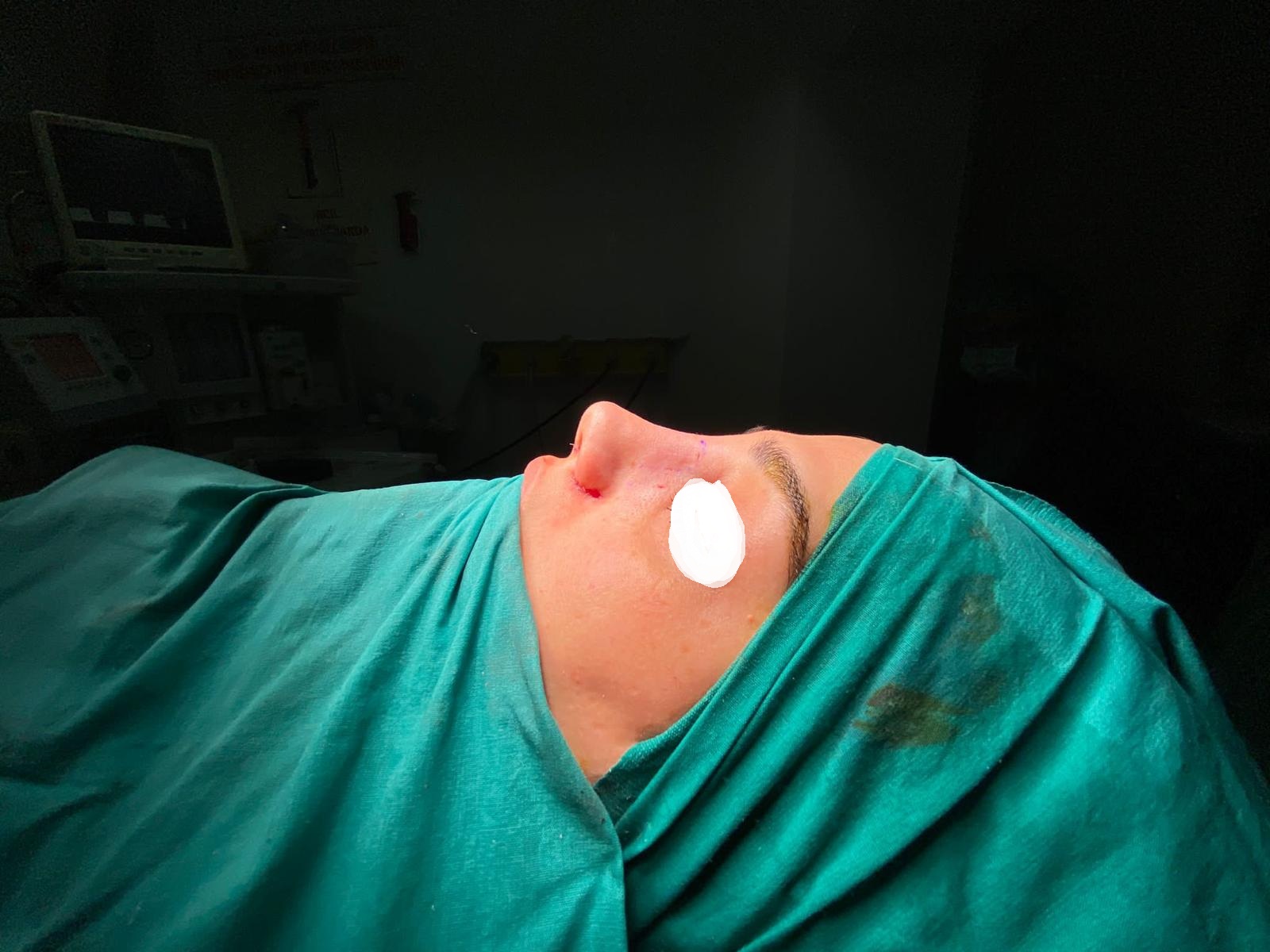 HairXNose rhinoplasty before and after case image 21