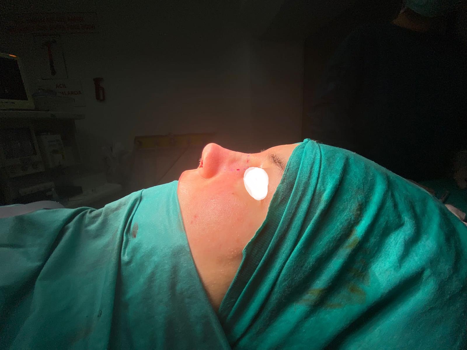 HairXNose rhinoplasty before and after case image 24