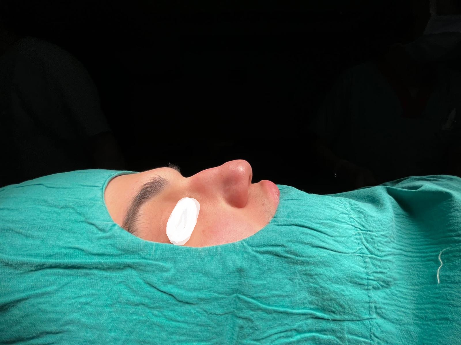 HairXNose rhinoplasty before and after case image 25
