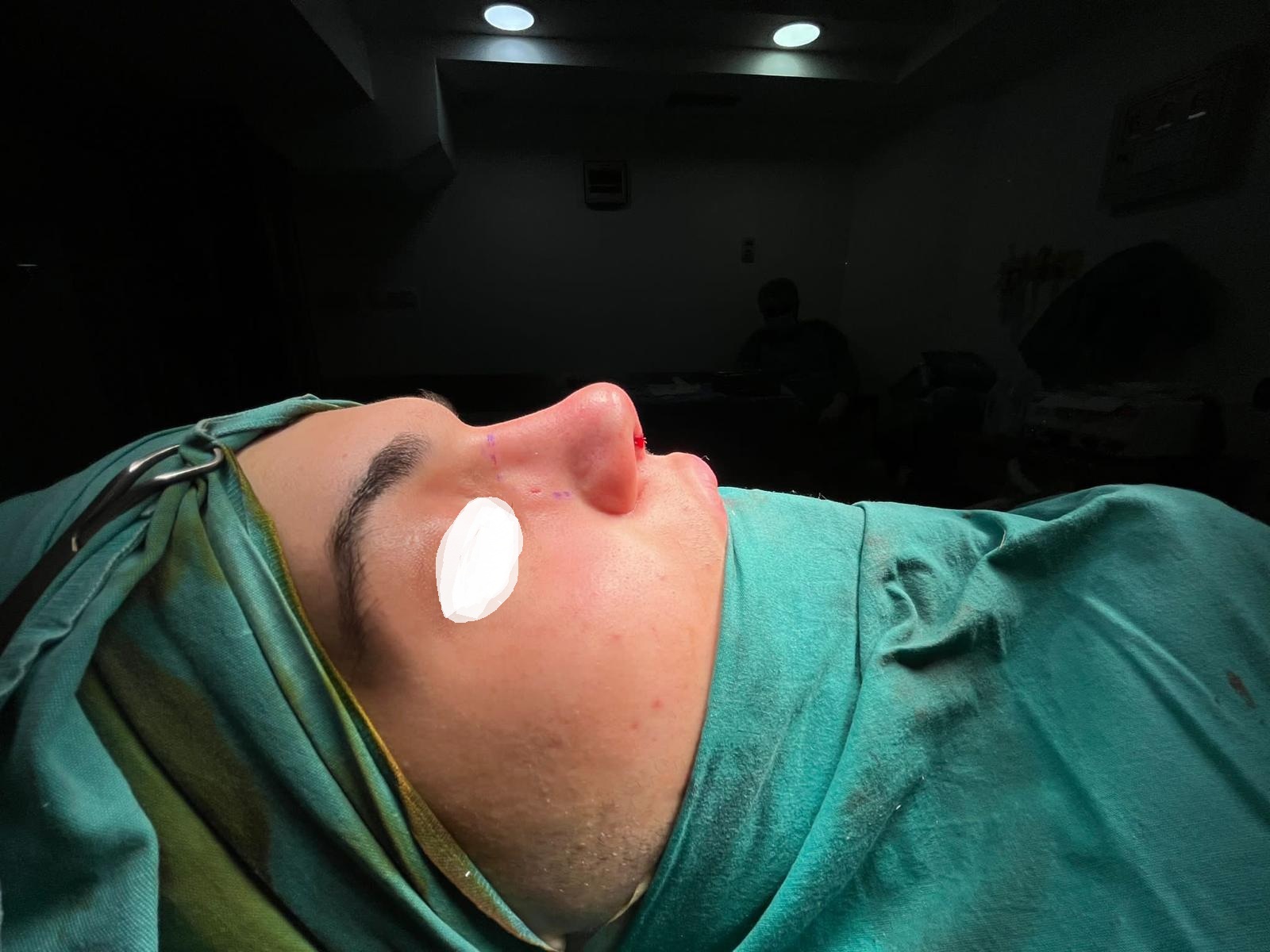 HairXNose rhinoplasty before and after case image 26