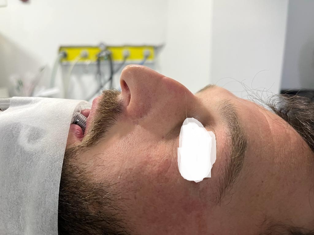 HairXNose rhinoplasty before and after case image 27
