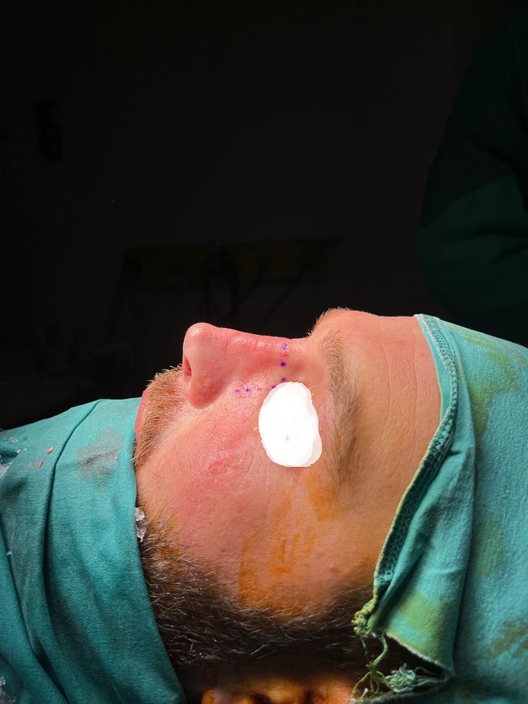 HairXNose rhinoplasty before and after case image 28