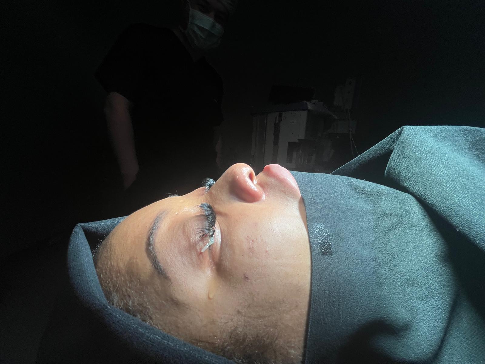 HairXNose rhinoplasty before and after case image 1