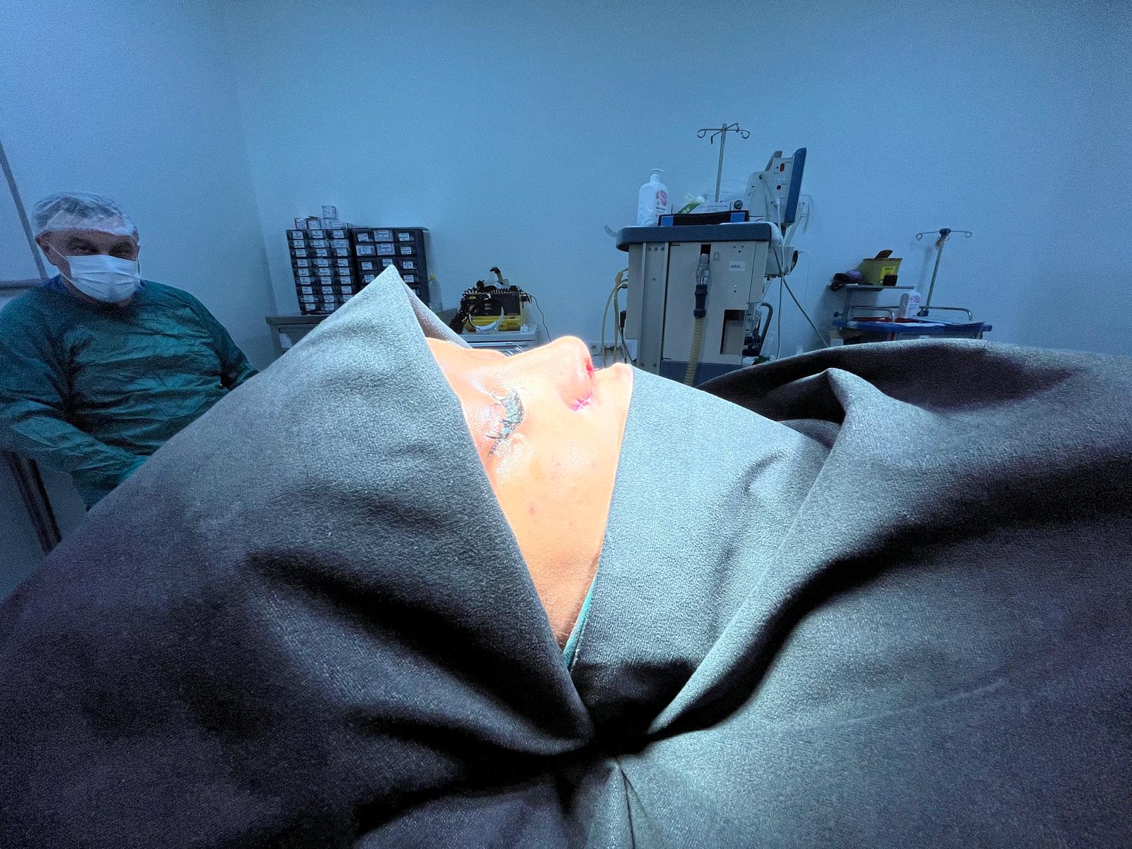 HairXNose rhinoplasty before and after case image 2